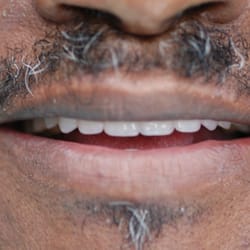 Adam M Hogan, DDS - Implant supported Overdentures.  No Glue!  No worries.  Supreme confidence.