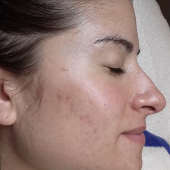 Houston Acne Specialists - Acne Treatment Near Me - Houston, Texas Houston Acne Specialists - Acne Treatment Near Me - Houston, Texas