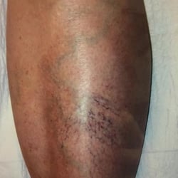 Neal T Foley, MD - Austin Vein and Vascular Clinic - BEFORE Sclerotherapy