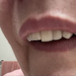 Dental Express - What they all want for procedure looks like atm