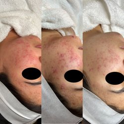 Hello Skin - Four month client progress