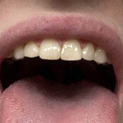 Kotch Dental - Miss Chapin teeth and you can see how round the lateral and sizer on the left side of the pic is(my right)