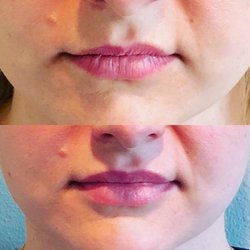 Levitt Medical Aesthetics - Results from a Botox lip flip