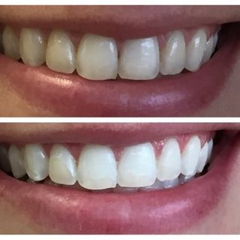 Mitchell Esral, DMD - Esral Dental - ZOOM Teeth Whitening - Great Results! - General Dentistry Near Me - Clark, New Jersey Mitchell Esral, DMD - Esral Dental - ZOOM Teeth Whitening - Great Results! - General Dentistry Near Me - Clark, New Jersey