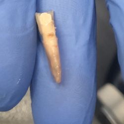 Leading Edge Oral Surgery Patchogue - The splinter out of my paw. Adios tooth. I won't miss you.