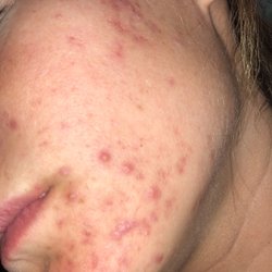 True Simplicity Acne & Skin Care - Long distance client before