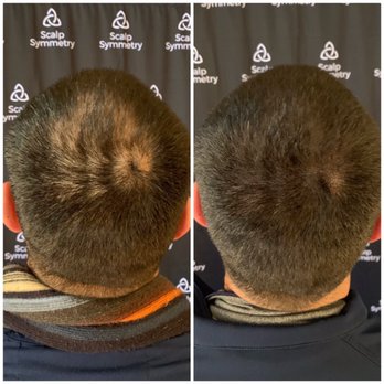 Scalp Symmetry - Scalp Micropigmentation - Hair Loss Centers Near Me - La Jolla, California Scalp Symmetry - Scalp Micropigmentation - Hair Loss Centers Near Me - La Jolla, California