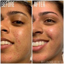 Leilani Malie Esthetics - Specializing in facials to treat acne at its source!