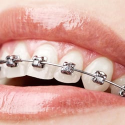 Ahrens Orthodontics - Louisville - Self-Ligating Brackets