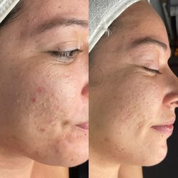 Acne bootcamp
