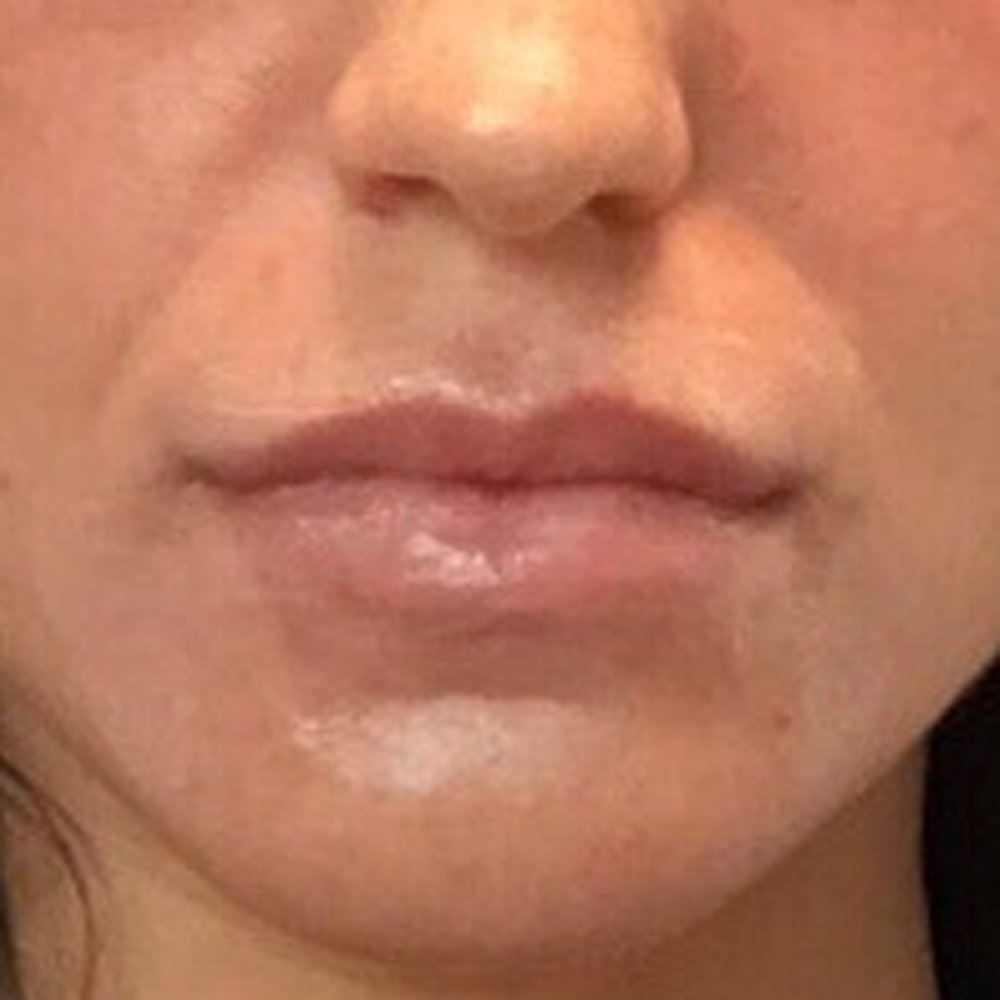 Jerry Darm, MD - Before lip filler w/ Dr. Sherbondy - Aestheticians Near Me - Lake Oswego, Oregon
