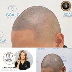 Scalp Micropigmentation Australia Adelaide - Hair Tattoo Scalp MicroPigmentation Adelaide Australia Before and After Result