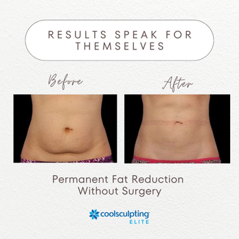 Vitali Medspa - CoolSculpting Elite - Medical Spas Near Me - Pooler, Georgia