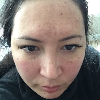 REN Dermatology and Aesthetics - 2 days post IPL. I have scarring cream on. Gaps in laser since it wasn't overlapped. Forehead may be slightly burned. - Dermatologists Near Me - Franklin, Tennessee