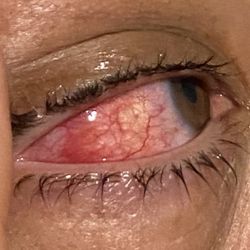 Royal Columbian Hospital - My eye :(
