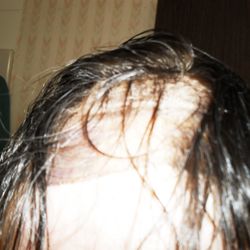 14 months after purchase. Hair system loses hair everyday. Courtesy of Maria Jaggard Salon. Langley, BC or vancouverhairloss.com