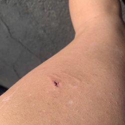 The dog punctured my skin with its teeth