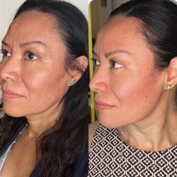 Body By Lonnie Med Spa - Facial Contouring (Botox, Under Eye Filler, Collagen Filler)