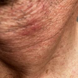 Z-ROC Dermatology