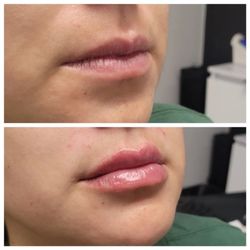 The Botox Spot