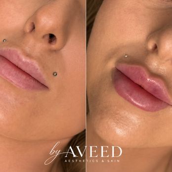 By Aveed - Medical Spas Near Me - Mill Creek, Washington By Aveed - Medical Spas Near Me - Mill Creek, Washington