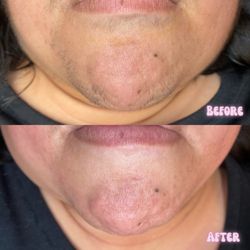 Glo By Brenda - Before and After Chin and Lower Lip wax