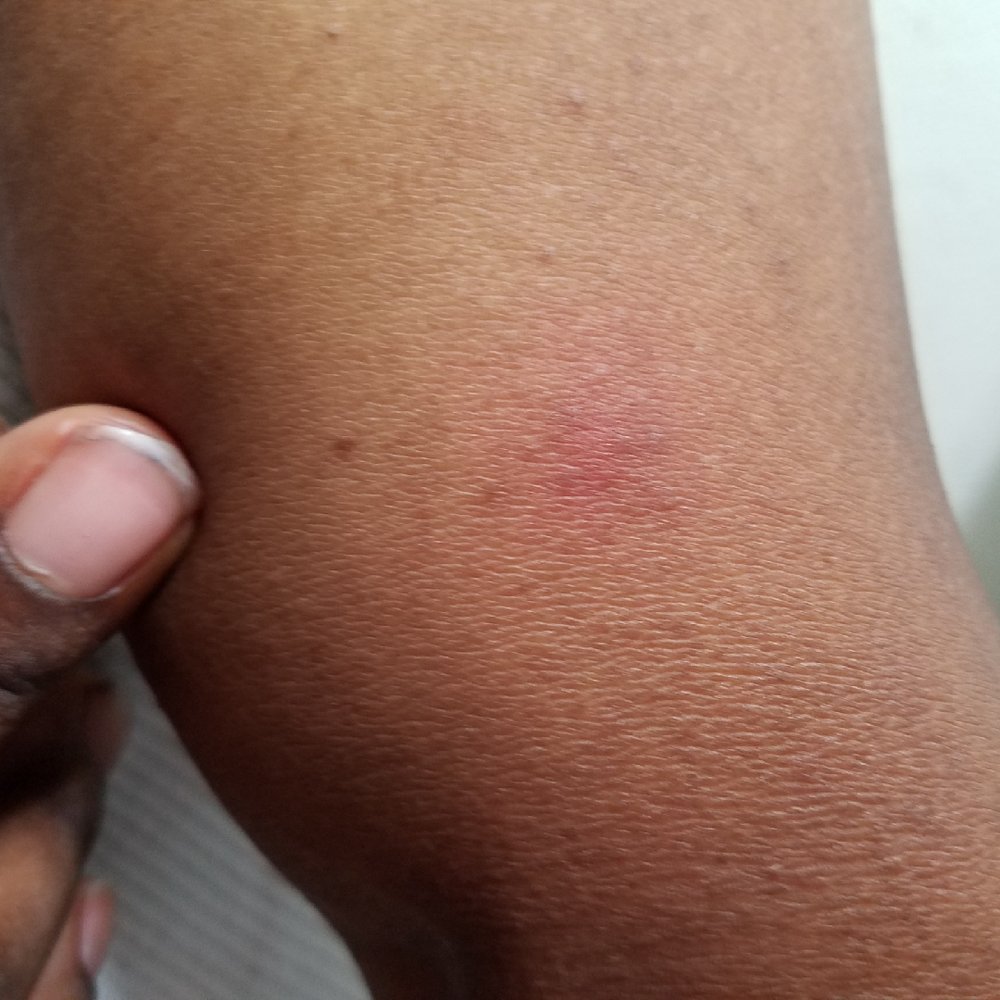 Bites from BEDBUGS on my mother Bites from BEDBUGS on my mother