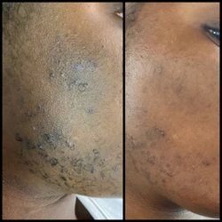 Organic Facial Experience Medical Day Spa - Excessive hair growth, caused by PCOS. Treatment: laser hair removal with skin brightening treatments.
