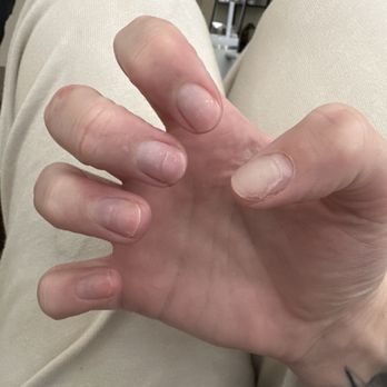 Nails 19 - Right hand. Same thing, not all product removed. You can also see on my ring finger that it is discolored - Nail Salons Near Me - Roseville, California Nails 19 - Right hand. Same thing, not all product removed. You can also see on my ring finger that it is discolored - Nail Salons Near Me - Roseville, California