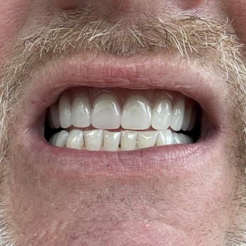 Modern Dental Arts - My completed new implants except for the six bottom teeth - Oral Surgeons Near Me - Waterford, Connecticut Modern Dental Arts - My completed new implants except for the six bottom teeth - Oral Surgeons Near Me - Waterford, Connecticut