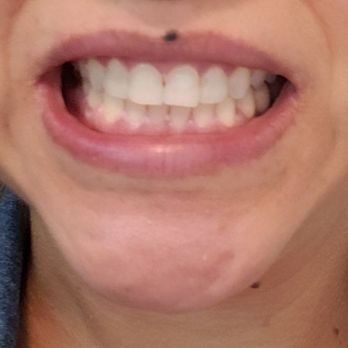 Bella Sorriso - After result, better lighting :-) - Teeth Whitening Near Me - Murrieta, California Bella Sorriso - After result, better lighting :-) - Teeth Whitening Near Me - Murrieta, California