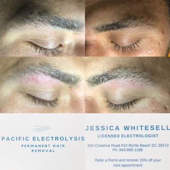 Pacific Electrolysis - Before and after under eyebrow shaping + contact info - Hair Removal Near Me - Myrtle Beach, South Carolina Pacific Electrolysis - Before and after under eyebrow shaping + contact info - Hair Removal Near Me - Myrtle Beach, South Carolina