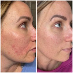 The Skin Standard - I had decent skin all my life and then I had two kids, stayed off birth control, turned 33 and had the worst acne of my life.