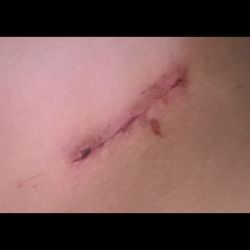 Zuri Plastic Surgery - There were concerns about the quality of the incision site.