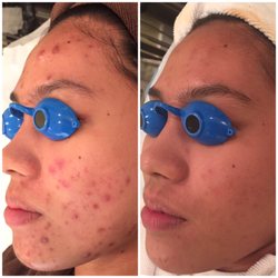 Vital Skin Care Studio - Acne Free Program