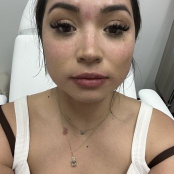 Beauty By The Bay - immediately after first appointment. .7ml lip filler. 50 units botox to forehead, eyebrows and masseters. - Medical Spas Near Me - Burlingame, California Beauty By The Bay - immediately after first appointment. .7ml lip filler. 50 units botox to forehead, eyebrows and masseters. - Medical Spas Near Me - Burlingame, California