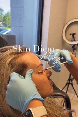 Injectables: Botox and Dermal Fillers - Botox: Unlock the secret to a smoother, more youthful complexion with our Botox treatments. Botox is a highly purified protein that works by relaxing targeted muscles, effectively softening dynamic facial lines and wrinkles. This quick, minimally invasive procedure can rejuvenate your appearance in just minutes, with results that last approximately 3 to 4 months. For those looking to diminish frown lines and wrinkles further, Dysport serves as an excellent alternative, offering similar smoothing effects.
Dermal Fillers: Transform your skin with our FDA-approved Dermal Fillers. Made from pure hyaluronic acid, a substance naturally occurring in human tissue, these fillers are expertly designed to correct imperfections such as acne scars, wrinkles, furrows, and fine lines. The visible benefits of dermal filler treatments can last 6 to 12 months, varying with the treatment's location and your skin's unique characteristics. Whether you're looking to restore volume, smooth out lines, or enhance facial contours, our dermal fillers provide a safe and effective solution for achieving your desired aesthetic. Injectables: Botox and Dermal Fillers - Botox: Unlock the secret to a smoother, more youthful complexion with our Botox treatments. Botox is a highly purified protein that works by relaxing targeted muscles, effectively softening dynamic facial lines and wrinkles. This quick, minimally invasive procedure can rejuvenate your appearance in just minutes, with results that last approximately 3 to 4 months. For those looking to diminish frown lines and wrinkles further, Dysport serves as an excellent alternative, offering similar smoothing effects.
Dermal Fillers: Transform your skin with our FDA-approved Dermal Fillers. Made from pure hyaluronic acid, a substance naturally occurring in human tissue, these fillers are expertly designed to correct imperfections such as acne scars, wrinkles, furrows, and fine lines. The visible benefits of dermal filler treatments can last 6 to 12 months, varying with the treatment's location and your skin's unique characteristics. Whether you're looking to restore volume, smooth out lines, or enhance facial contours, our dermal fillers provide a safe and effective solution for achieving your desired aesthetic.