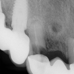 Advanta Dental - Ill-fitting bridge courtesy of Dr. Rahm.  Entire support rotted.  This buck-toothed, cemented-in-sideways bridge literally makes me sick.