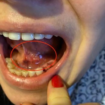 Affordable Dentures - Bruising that followed under my tongue - General Dentistry Near Me - Mesquite, Texas Affordable Dentures - Bruising that followed under my tongue - General Dentistry Near Me - Mesquite, Texas