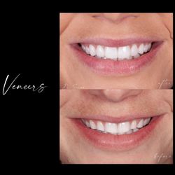 Lombardi Brothers Dental - Veneers