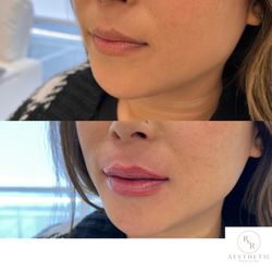 R & R Aesthetic Medicine - Gorgeous lips with 1/2 syringe filler