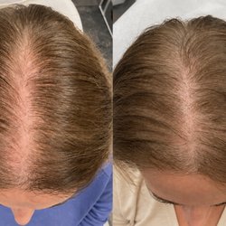 Get Glowing Medspa - PRP Hair Restoration