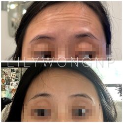 Lily Wong - Botox before and after