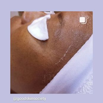Good Skin Society - Dead skin be gone! add-on dermaplane to any custom facial for an additional $15. - Skin Care Near Me - Escondido, California Good Skin Society - Dead skin be gone! add-on dermaplane to any custom facial for an additional $15. - Skin Care Near Me - Escondido, California