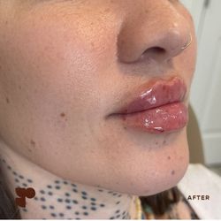 Pretty Please Aesthetics - Lip Enhancement