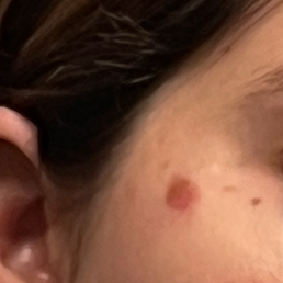Scarring Scarring