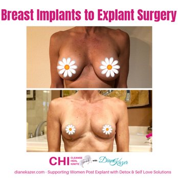 Diane Kazer - Struggling with Breast Implant Illness, even post explant? We can help. - Nutritionists Near Me Diane Kazer - Struggling with Breast Implant Illness, even post explant? We can help. - Nutritionists Near Me