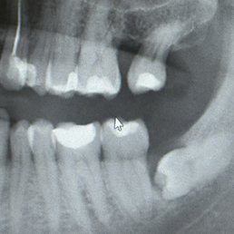 Before removing my wisdom tooth