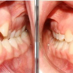 Upland Dental Implant & Orthodontics - Crossbite correction before and after