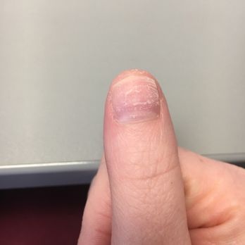 Joy Nails & Spa - Nail fell off - Nail Salons Near Me - Oceanside, California